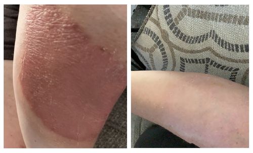 Customer photo review of BotemedelsKräm™ Psoriasis & Eksem Naturlig Kräm