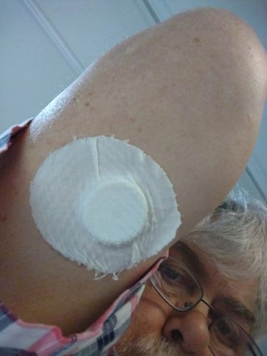 Customer photo review of Skin Grip Freestyle Libre Adhesive Patches