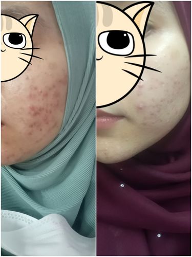 Customer photo review of DUO SERUM SET