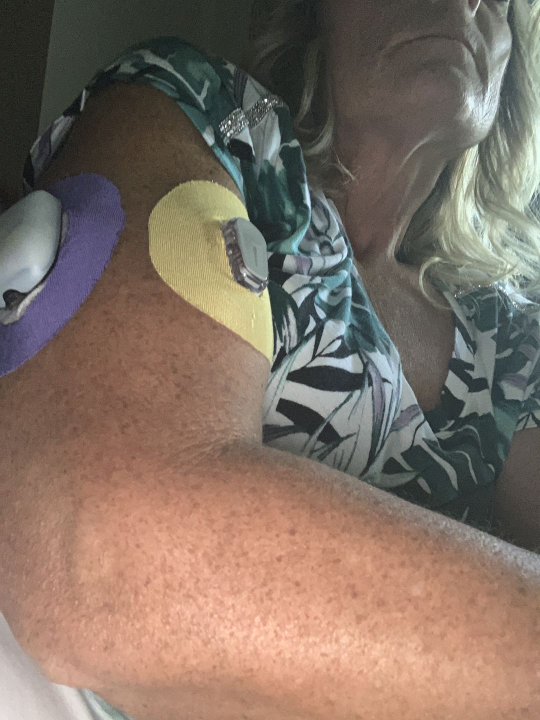 Customer photo review of Skin Grip Omnipod Adhesive Patches