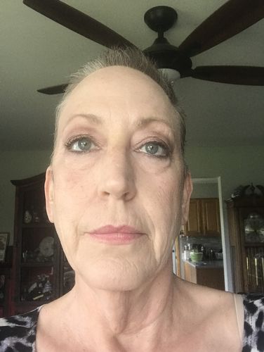 Customer photo review of EvenSkyn® Lumo: Premium Anti-Aging & Skin Tightening Handset