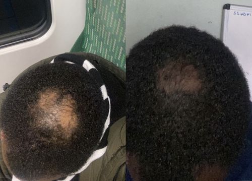 Customer photo review of Grow Pro: Derma Roller for Hair & Beard