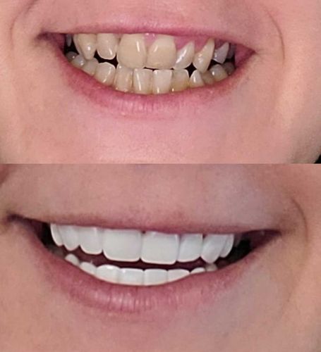 Customer photo review of Teeth-Veneer 2.0