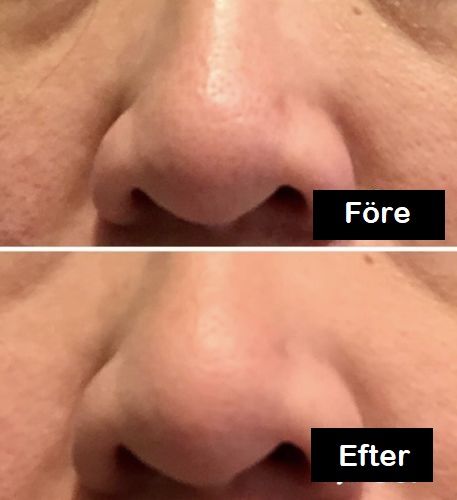 Customer photo review of PorSerum™ Concealer för Porer