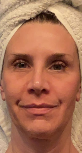 Customer photo review of EvenSkyn® Lumo: Premium Anti-Aging & Skin Tightening Handset