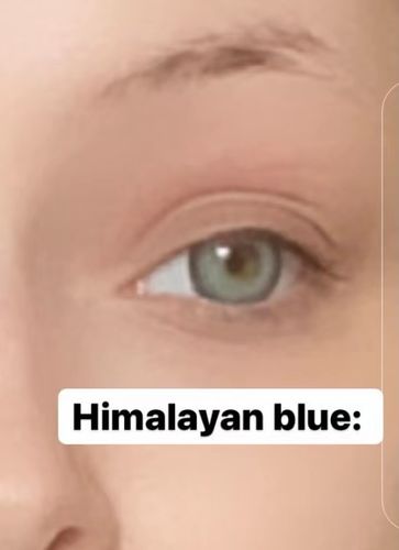 Customer photo review of Himalaya Blue Contact Lenses(12 months of use)
