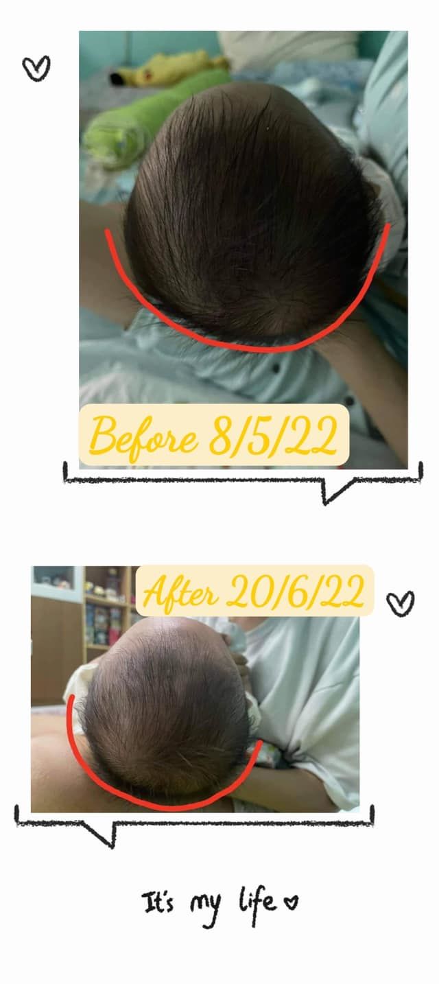 Customer photo review of BSB Head Shaping Pillow ( Upgrade.Ver )