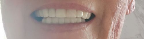 Customer photo review of Teeth-Veneer 2.0