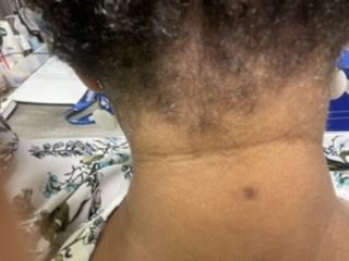 Customer photo review of Psoriasis Honey Scalp Nourishing Kit