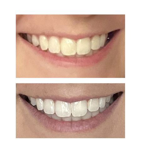 Customer photo review of bedrō Whitening