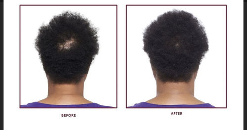 Customer photo review of Hair Recovery Bundle