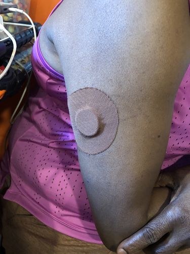Customer photo review of Skin Grip Freestyle Libre Adhesive Patches