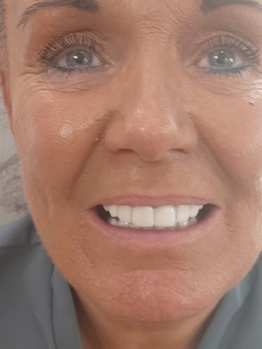 Customer photo review of Teeth-Veneer 2.0