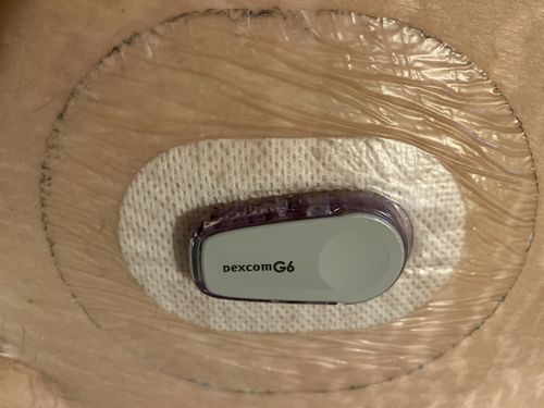 Customer photo review of Skin Grip Dexcom G6 Patches
