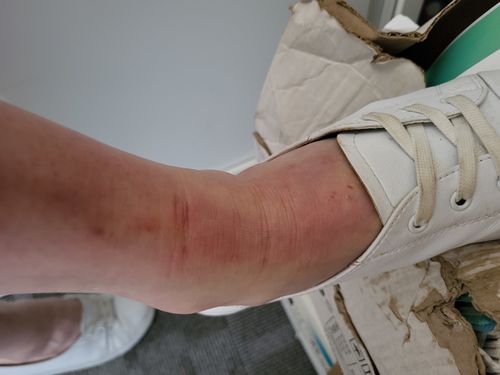 Customer photo review of Coco 清爽保濕套裝 (濕疹修護霜+蘆薈舒緩保濕凝膠)