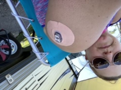 Customer photo review of Skin Grip Dexcom G6 Patches
