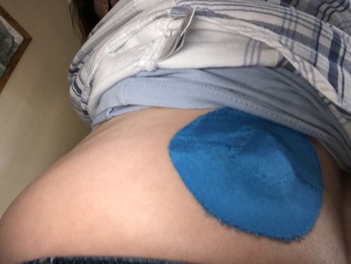 Customer photo review of Skin Grip Medtronic Guardian/Enlite/Libre Adhesive Patches
