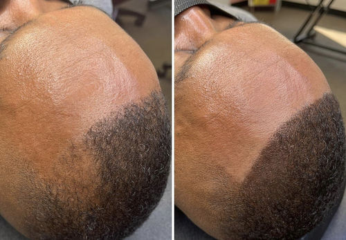 Customer photo review of Scalpa Numb - Pre Procedure