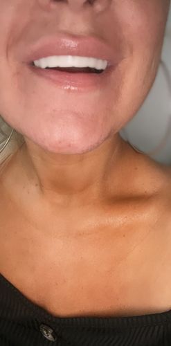 Customer photo review of Teeth-Veneer 2.0