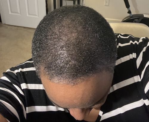 Customer photo review of Trio Set: African Black Soap Hair Growth Shampoo, Hair Growth Oil, and Hair Growth Conditioner