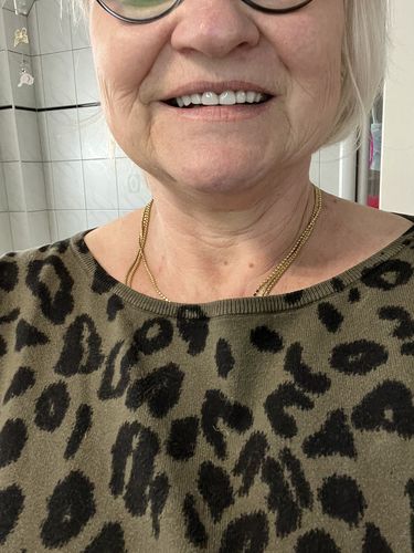 Customer photo review of Teeth-Veneer 2.0