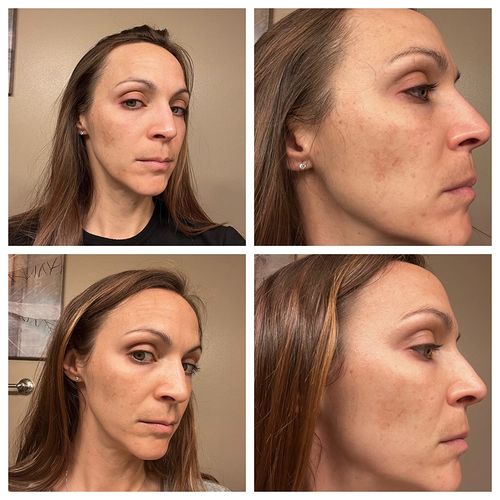 Customer photo review of Lanthome™ Fixa och ta bort Mörka Fläckar