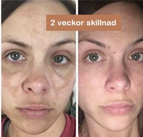 Customer photo review of Lanthome™ Fixa och ta bort Mörka Fläckar