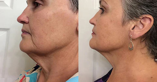 Customer photo review of VLyft™ Avancerad Nacka Åtstramningskräm