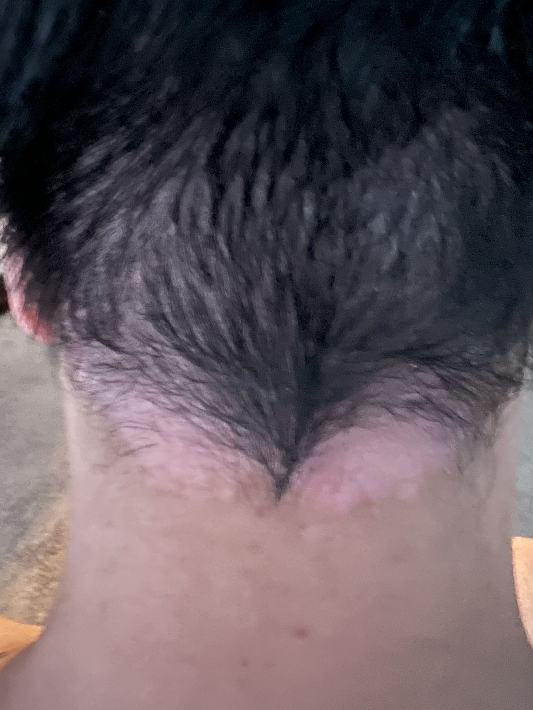 Customer photo review of Psoriasis Honey Renewing Shampoo