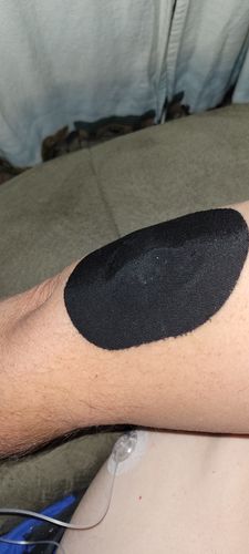 Customer photo review of Skin Grip Medtronic Guardian/Enlite/Libre Adhesive Patches