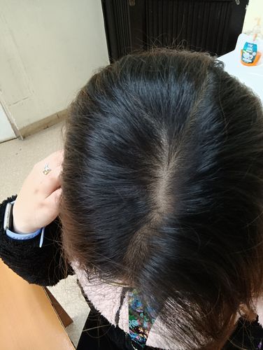 Customer photo review of PACK SHAMPOO ANTICASPA GRASA+ ACONDICIONADOR  300 ML