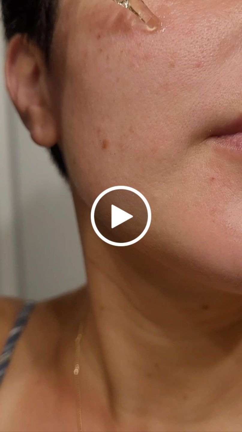 Customer video review of Psoriasis Honey Nourishing Scalp and Skin Serum