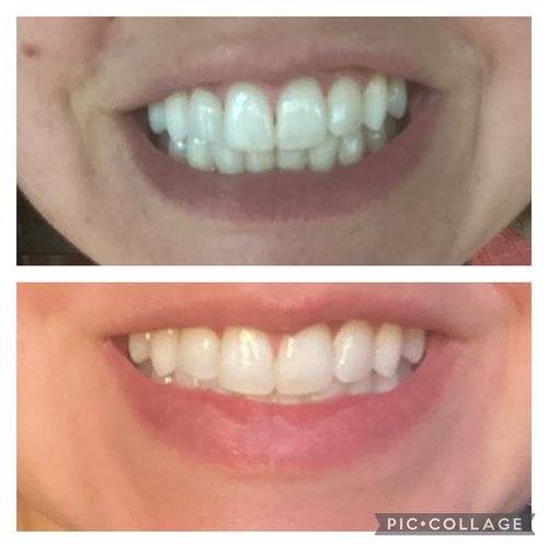 Customer photo review of bedrō Whitening