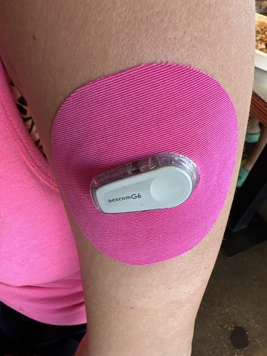 Customer photo review of Skin Grip Dexcom G6 Patches