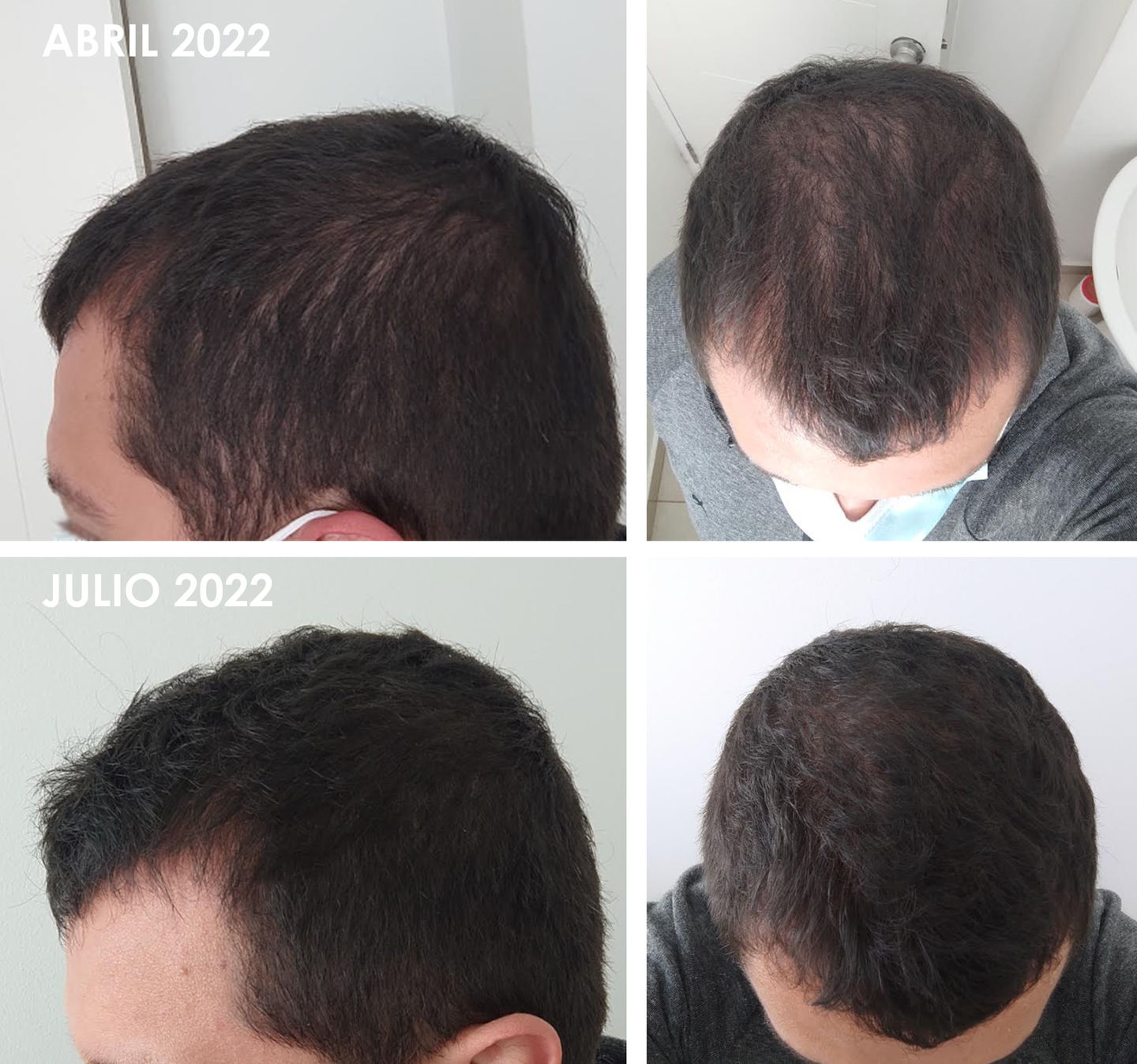 Customer photo review of Anticaída para 3 meses