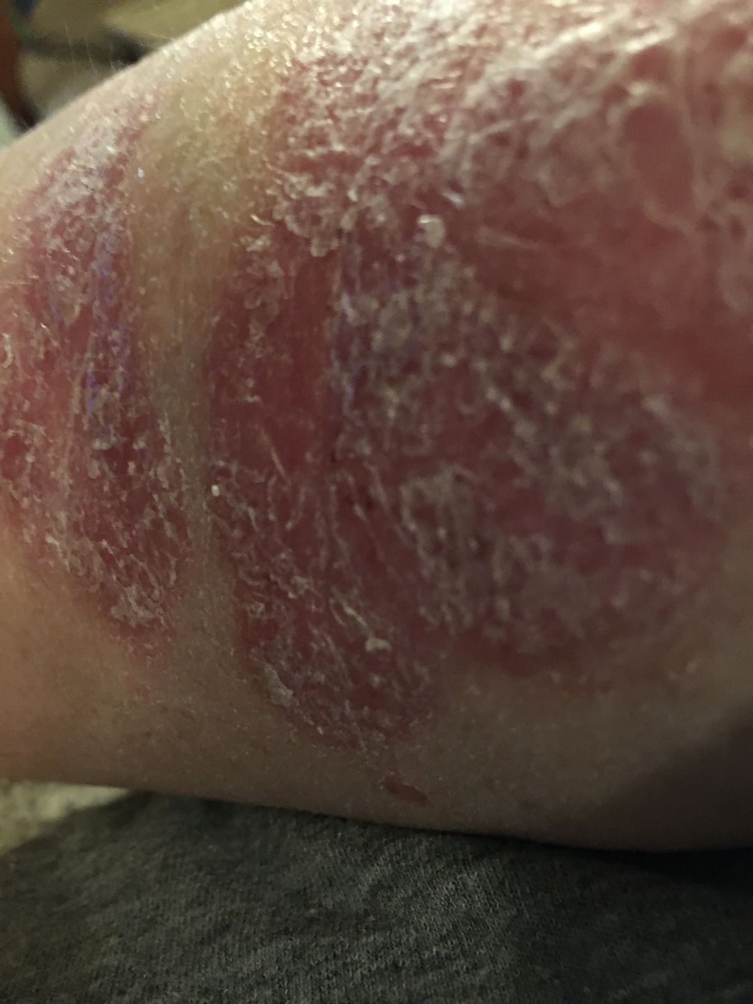 Customer photo review of Psoriasis Honey Scalp Nourishing Kit