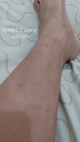 Customer photo review of Jolicare™ Treatment Set - Special Offer
