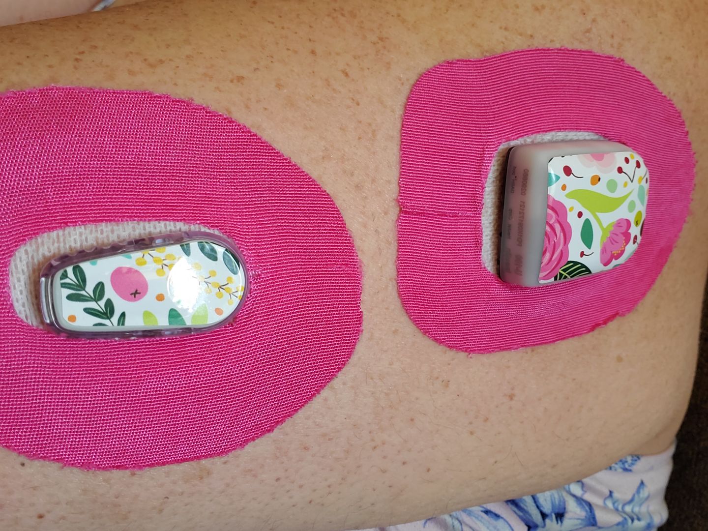 Customer photo review of Skin Grip Omnipod Adhesive Patches