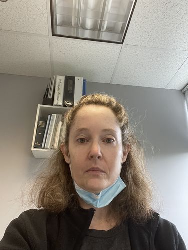 Customer photo review of JawlineFix: Filler