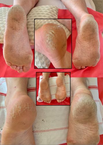 Customer photo review of LOVASKIN INSTANT FOOT PEEL Deluxe Kit - 25 Beauty treatments