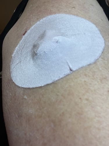 Customer photo review of Skin Grip Medtronic Guardian/Enlite/Libre Adhesive Patches