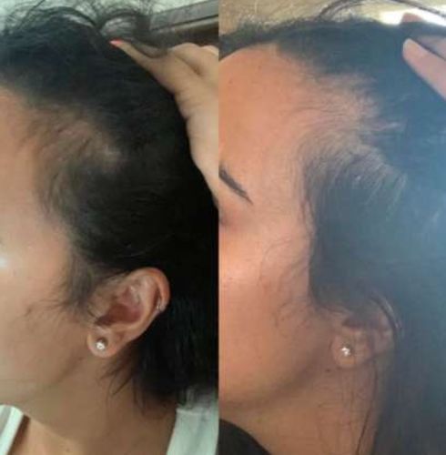 Customer photo review of HairRebirth Herbal Spray（Limited time discount 🔥 last day）