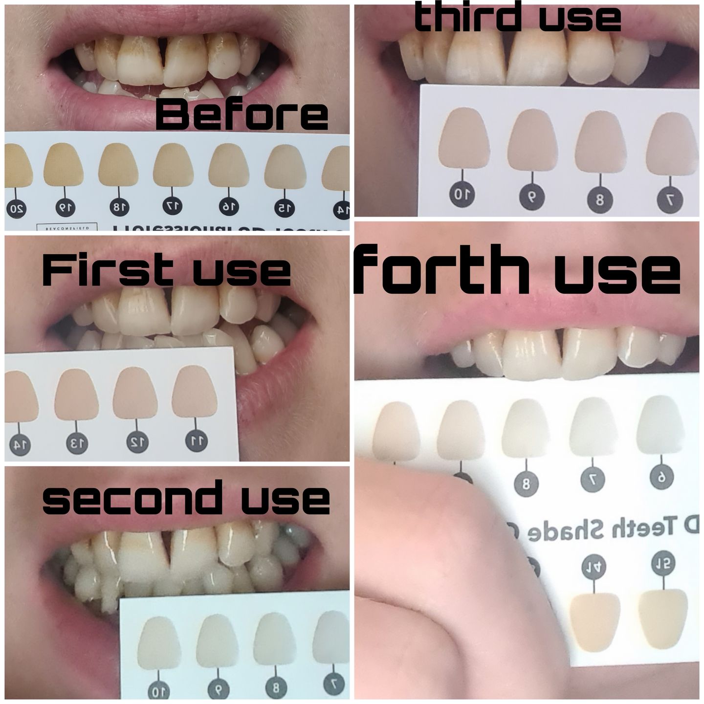 Customer photo review of Ultimate Teeth Whitening Bundle