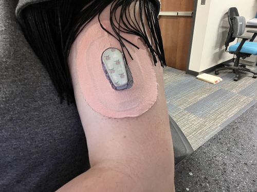 Customer photo review of Skin Grip Dexcom G6 Patches