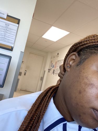 Customer photo review of FRESH FADE DARK SPOT CLEANSER (20% OFF - SOFT LAUNCH PACKAGING)