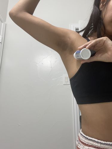 Customer photo review of THE MAGIC STICK INGROWN HAIR AND DARK SPOT TREATMENT