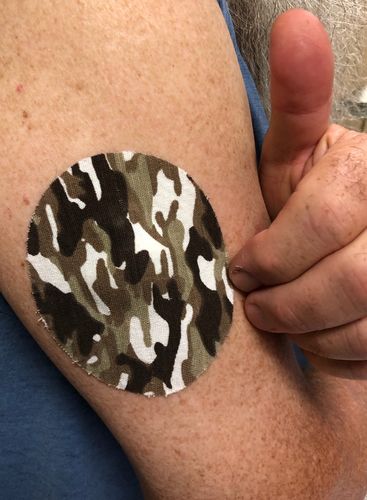 Customer photo review of Skin Grip Medtronic Guardian/Enlite/Libre Adhesive Patches