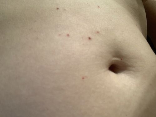 Customer photo review of Dermavel - Fibroblast Plasma Pen