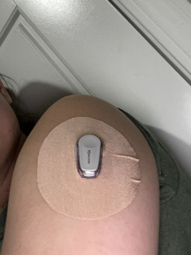 Customer photo review of Skin Grip Dexcom G6 Patches