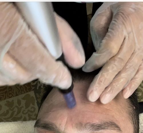 Customer photo review of Microneedle / Nanoneedle Cartridge